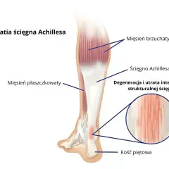 Anatomia łydki z zaznaczonymi mięśniami i ścięgnem Achillesa. Widoczna degeneracja ścięgna, wskazująca na tendinopatię.