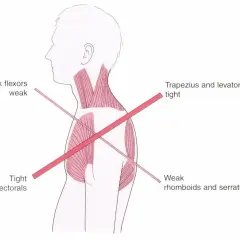 Anatomia mięśni: słabe zginacze karku, napięte kaptury i mięśnie łopatki, napięte mięśnie piersiowe, słabe mięśnie równoległoboczne i zębate przednie.