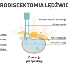 Ilustracja pokazuje etapy mikrodiscektomii lędźwiowej: przepuklinę krążka, operację z użyciem mikronarzędzi i usunięcie fragmentu krążka uciskającego nerw.