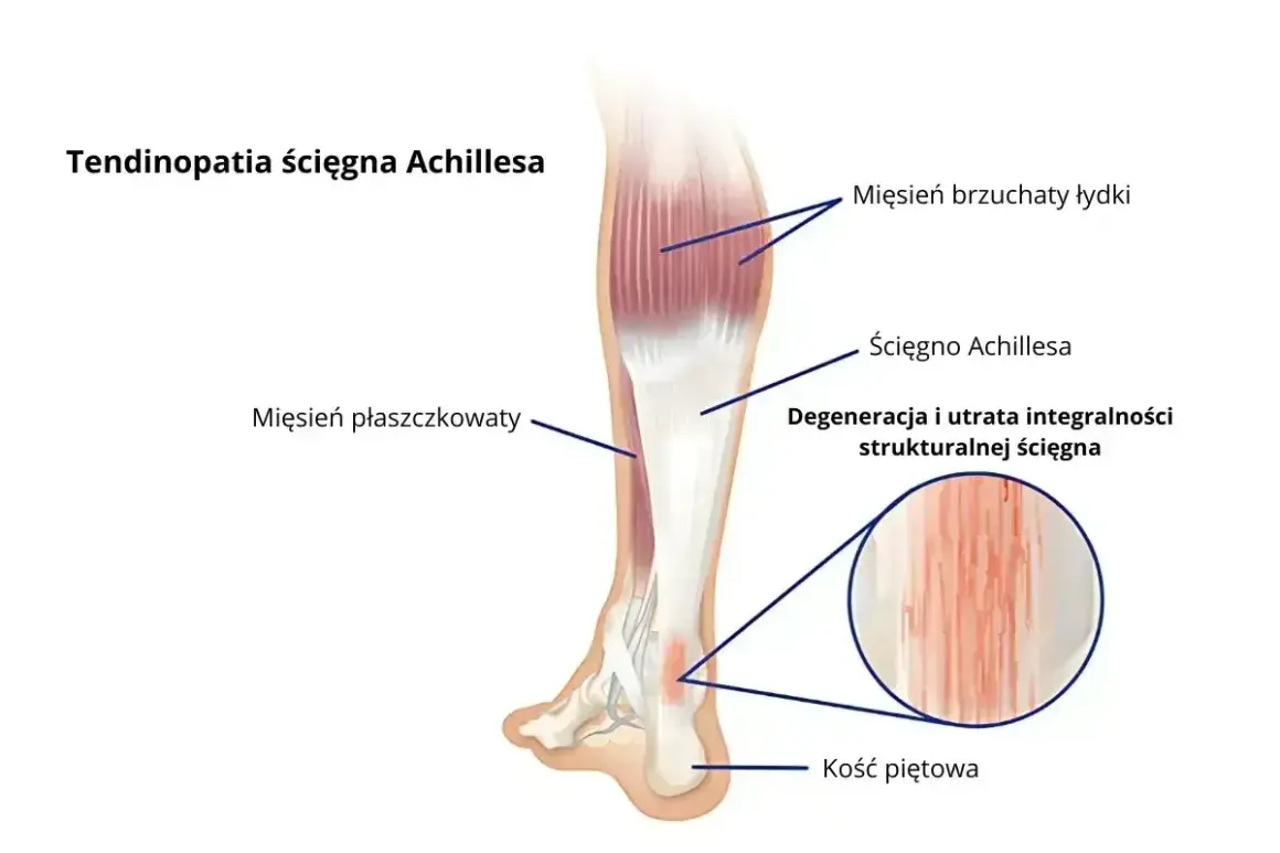 Anatomia łydki z zaznaczonymi mięśniami i ścięgnem Achillesa. Widoczna degeneracja ścięgna, wskazująca na tendinopatię.