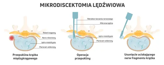 Mikrodiscektomia lędźwiowa - kiedy pomaga i jak wygląda powrót?